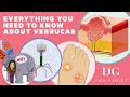 Everything you need to know about verrucas