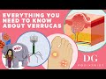 Everything you need to know about verrucas