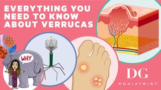 Everything you need to know about verrucas