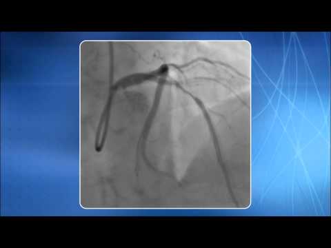 Chapter 8: TRA for addressing Bifurcation Lesions