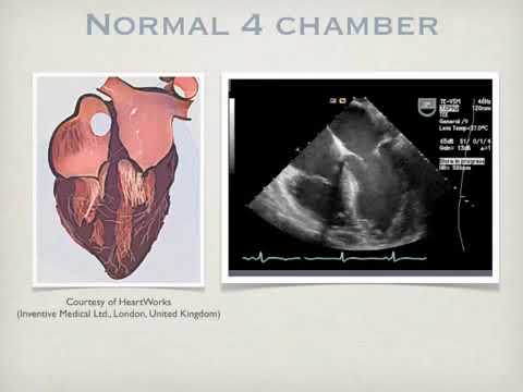 Transesophageal Echo, TEE ( Assessment of the Right Ventricle )