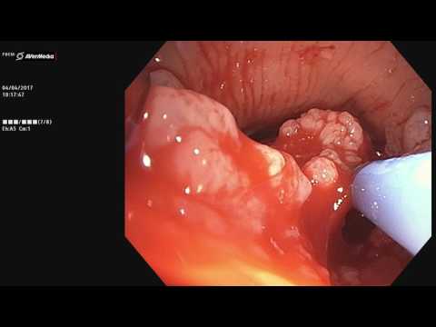 Colorectal cancer blood in stool