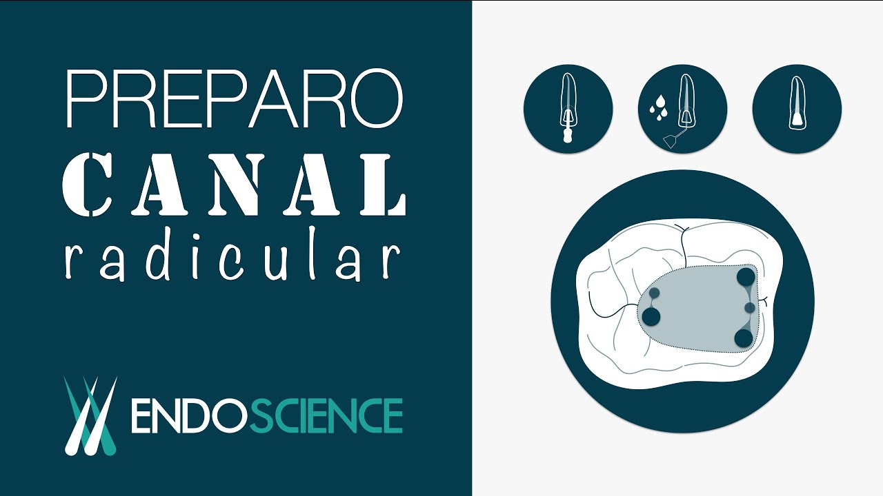 Princípios de preparo do Canal Radicular