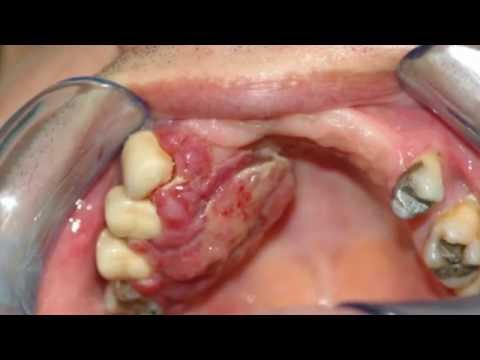 Cell papilloma removal