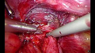 Large &amp; very deep Recto-vaginal DIE with rectal involvment