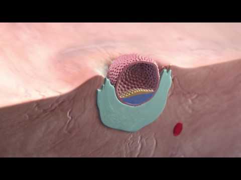 Implantation of the blastocyst