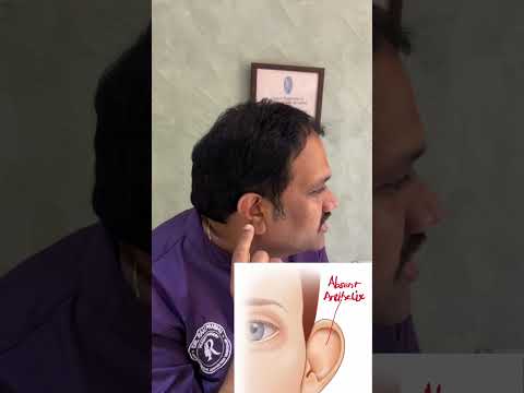 Prominent ear correction and otoplasty video by Dr. Ram Prabhu.