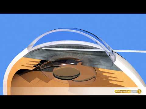 Augen-OP bei Glaukom: Grünen Star operieren