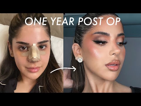 1 YEAR POST OP NOSE JOB UPDATE + Q&A