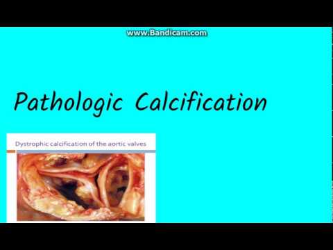 Pathologic Calcification - YouTube