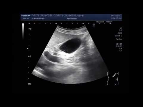 Giardiasis while pregnant