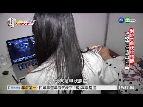 別輕忽甲狀腺結節 當心變癌影響健康