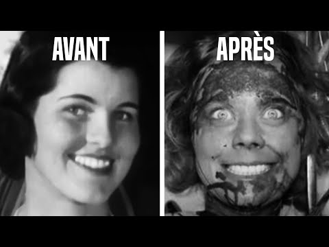 Here's Why Lobotomy Is The Worst Surgery In History