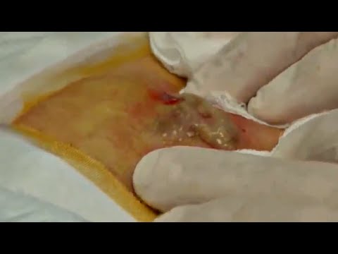 Best of Cyst Bursting   Cysts, Pimple Pops, Blackheads and Acne!