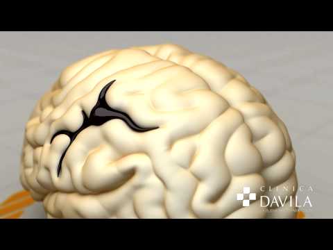 Video Clinica Davila Gamma Knife