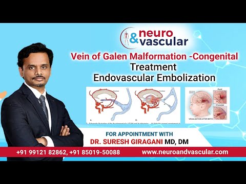 Breaking Medical Frontiers: Endovascular Embolization for Vein of Galen Malformation in Newborns