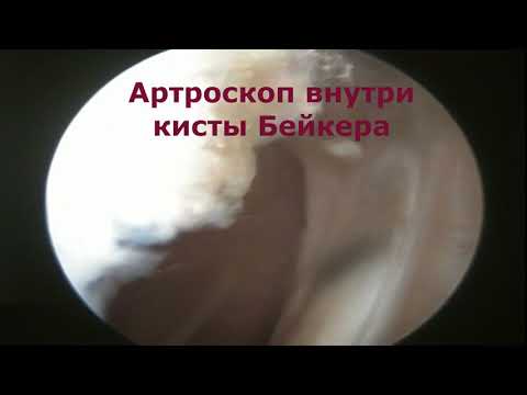 Операция на тазобедренный сустав смотреть видео Грыжа в грудном отдела позвоночника