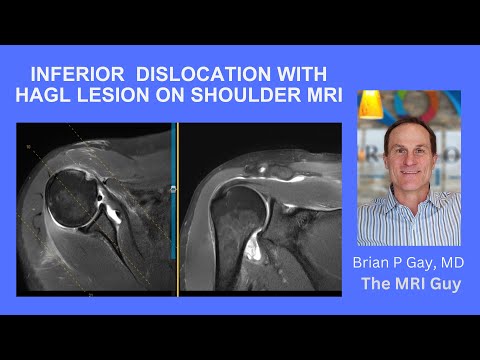 Inferior shoulder dislocation with HAGL lesion on MRI