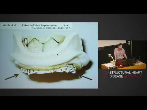 Mitral valve annular calcification - A surgeon's perspective - Prof Michael Vallely