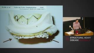 Mitral valve annular calcification – A surgeon’s perspective – Prof Michael Vallely