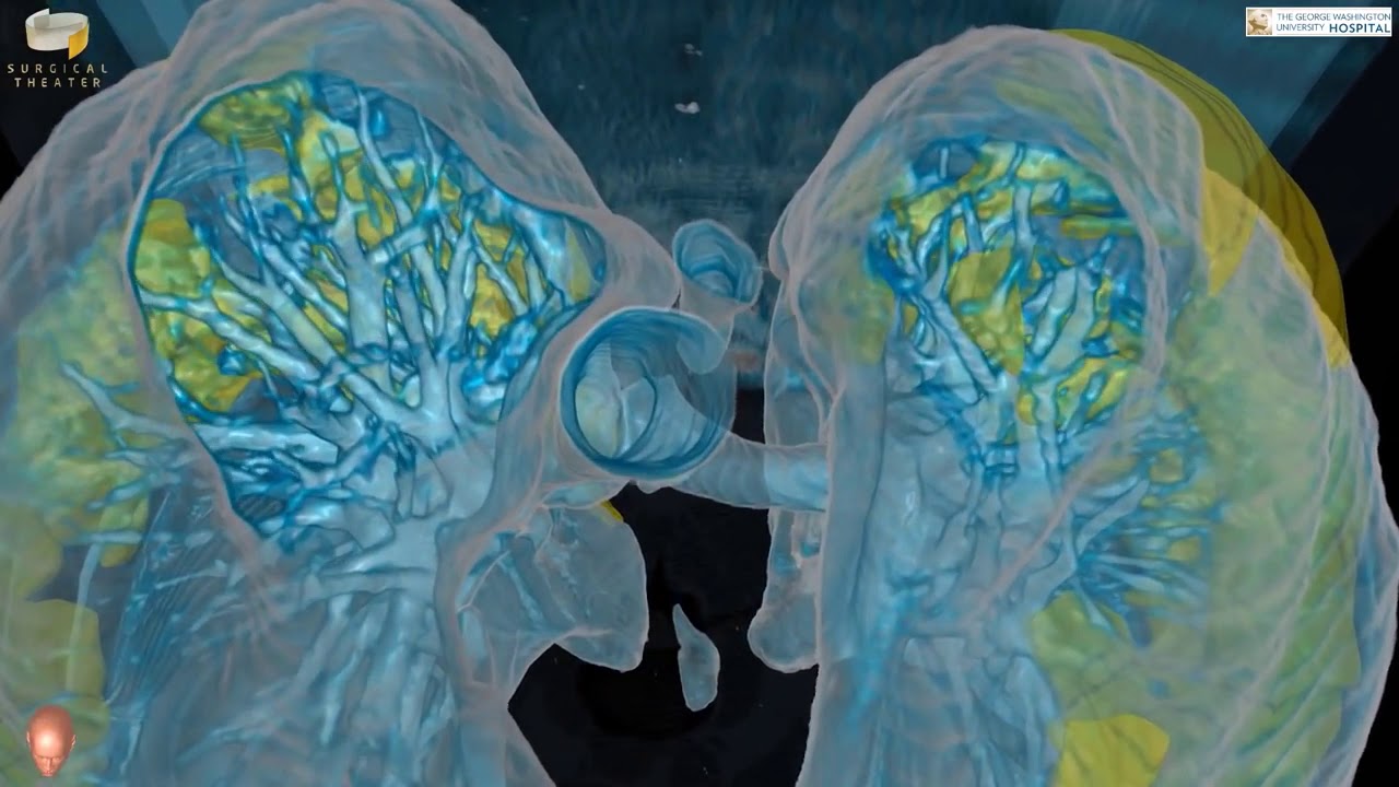 Koronavirüsün akciğerlere verdiği hasar görüntülendi