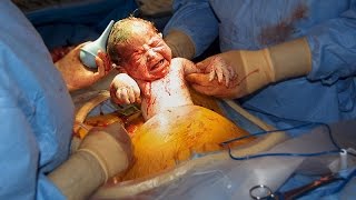 Caesarean Section-Giving Birth By Surgery, Baby Delivery