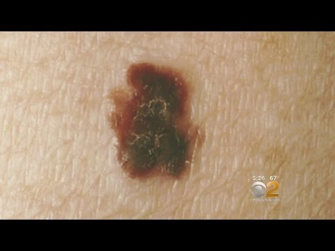 Melanoma Monday Puts Deadliest Form Of Skin Cancer In The Spotlight