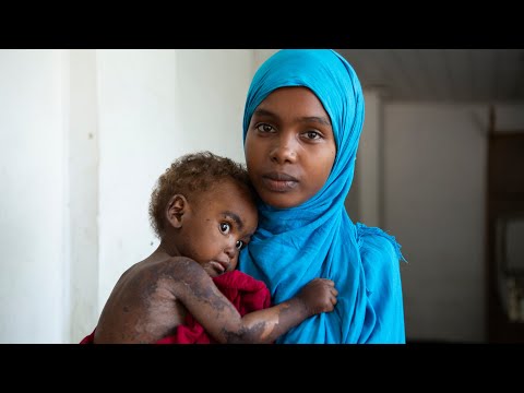 Child malnutrition in Somalia: A mother's challenges and perseverance