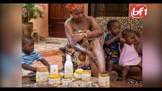 Dépigmentation : un nouveau phénomène inquiétant chez les petits-enfants
