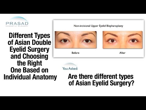 Determining Most Appropriate Type of Asian Double Eyelid Surgery Based on Individual Anatomy