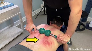 Patients Messed Up Their Spines! No one Saw This Coming! *Cracks* & Gua Sha