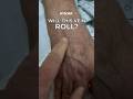 Will This Vein Roll Rolling Vein Iv