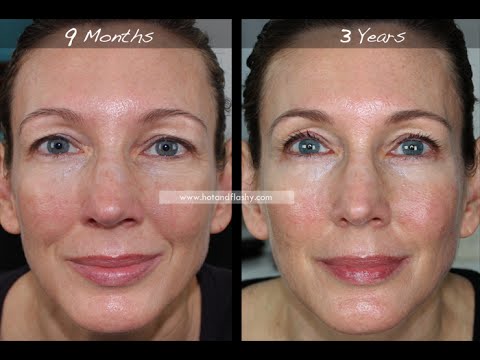 Retin-A for Anti-Aging | 3-Year Results | Before & After Video