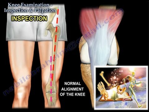 suprapatellar térdtáska kezelés