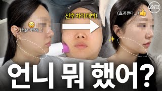 30대 피부 시술 두 가지로 정리하세요!