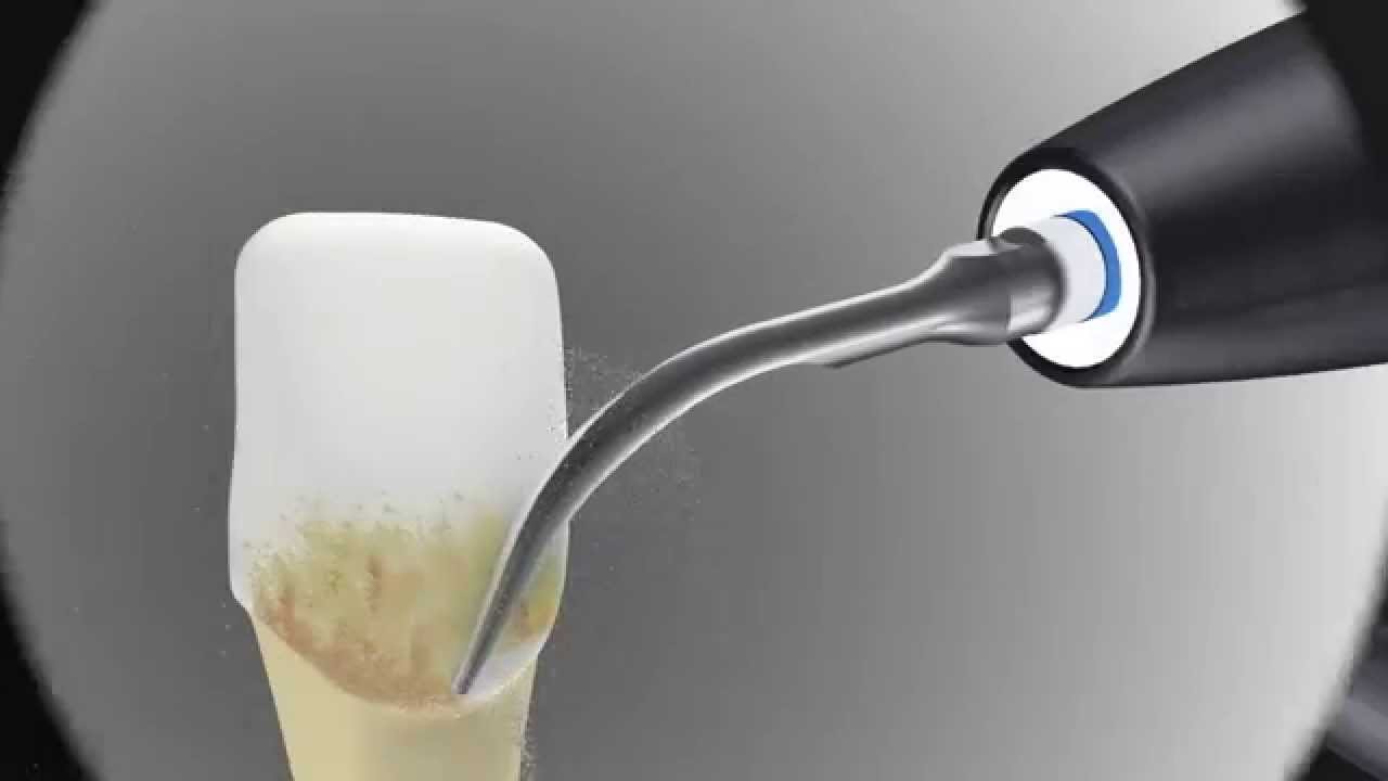 Les détartreurs Newtron Actéon