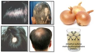 Onion Juice Cure Hair Loss and Promote Hair Regrowth : 100% Natural (In Hindi)