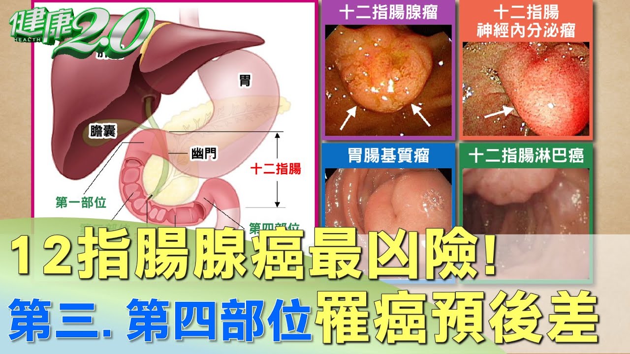 這症狀1年！女一照竟長瘤　醫嘆「十二指腸癌」易擴散