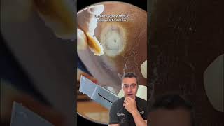 Satisfying Foot WART Removal!