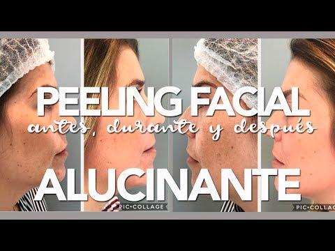 Decolorazione di pelle di un corpo Mosca Il pigmentary nota il trattamento di un couperosis