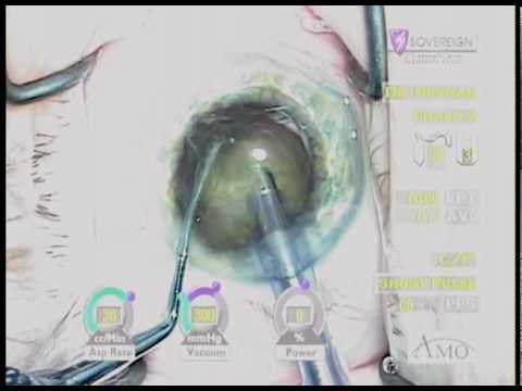 Phaco Chop Technique In Cataract Surgery