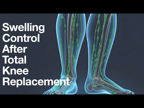 Knee Replacement Recovery: Beat The Swelling