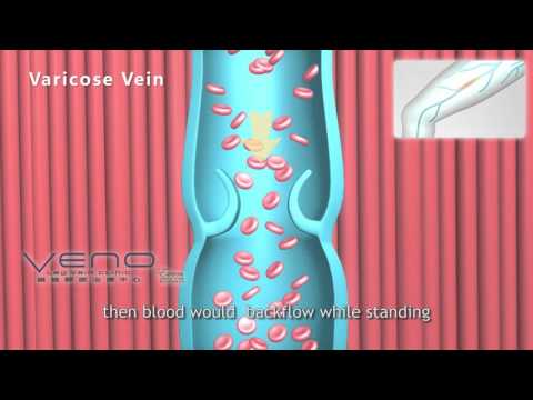 Varicose veins, varicose veins symptoms - Veno, leg Vein Clinic, hong kong