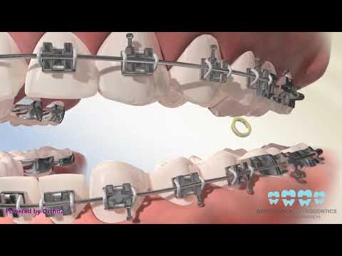 Posterior Crossbite Elastics