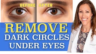 How to Get Rid of Dark Circles Under Eyes PERMANENTLY!