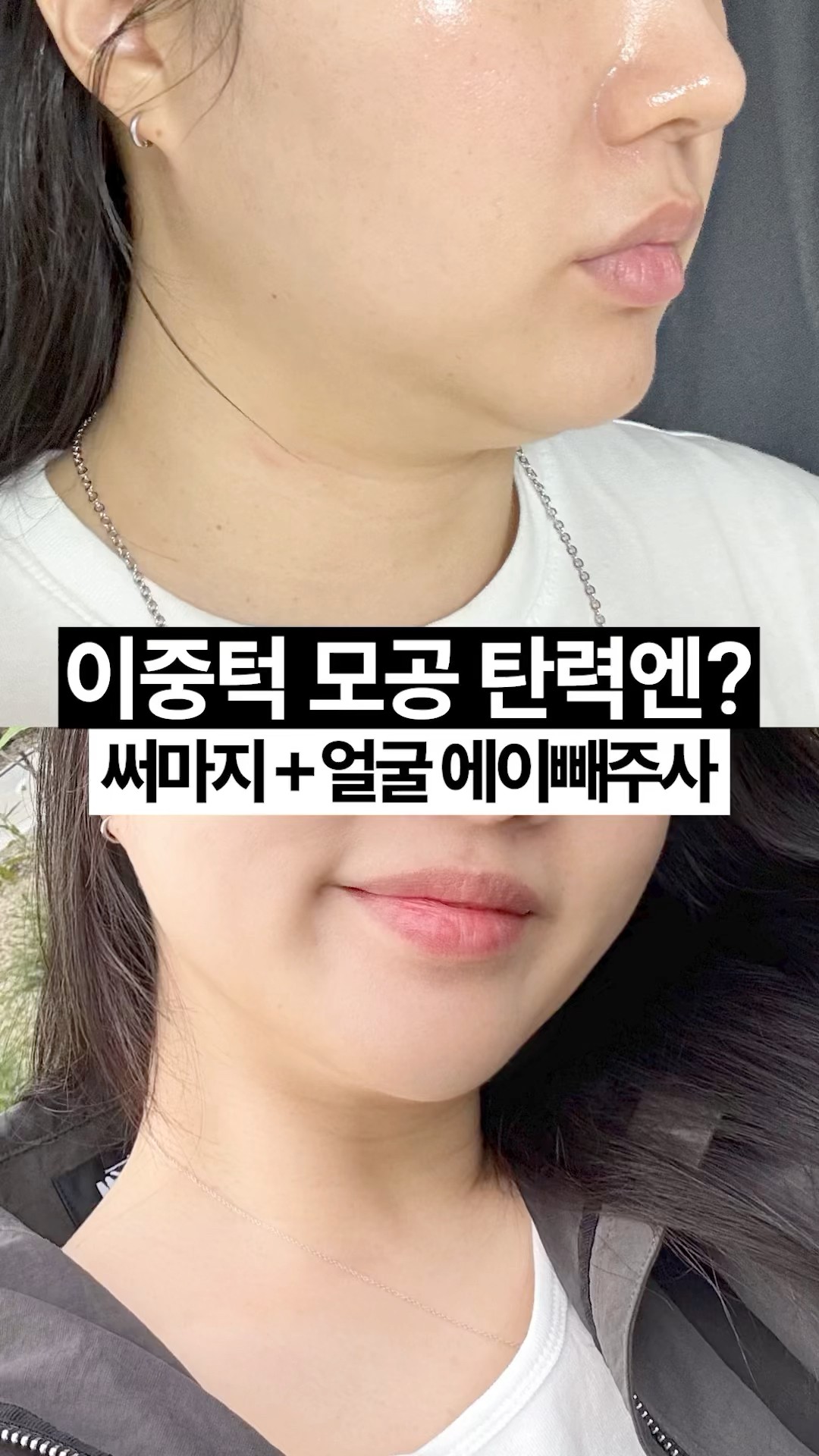 써마지+윤곽주사 후기