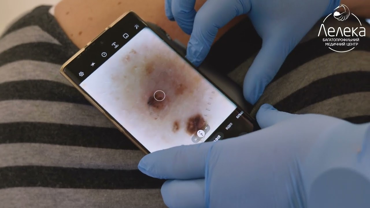 Видалення родимок на Печерську та на Оболоні в Києві | МЦ Лелека