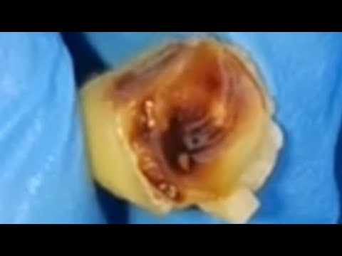 Endodontic Access Opening Step-by-Step