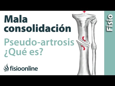 ¿Qué es la pseudoartrosis o mala consolidación de fracturas?