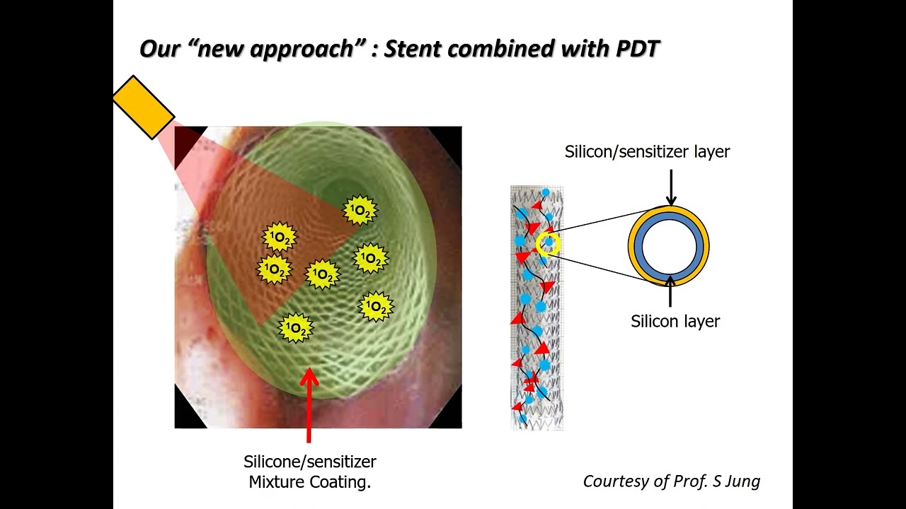 Biliary metal stent : Where ae we, and where do we need to go ? - Dong Ki Lee